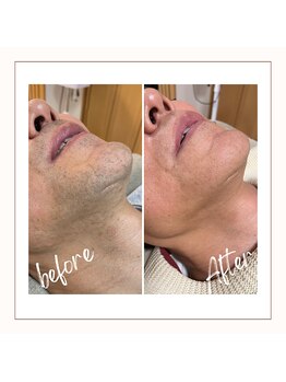 フルールスレーヌ(Fleur Sereine)/清潔感が一番☆本気の髭脱毛