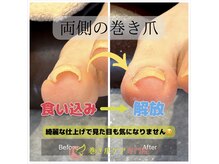 トラスト整体院 小池院/両側の巻き爪改善
