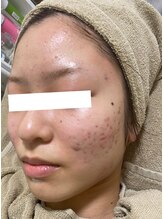 ノーブル 新宿南口(NOBLE)/新宿ハーブピーリングNOBLE