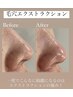 【超毛穴改善】毛穴エクストラクション×プラズマ微細針×エクソソーム