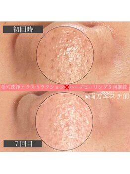 エミーニー(emiiny)/毛穴悩みから卒業しましょう!