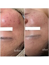 モンクラッシー(Mon classy)/赤みも鎮静できます。