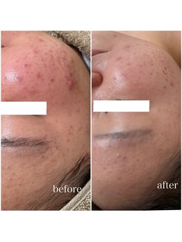 モンクラッシー(Mon classy)/赤みも鎮静できます。