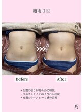 プラスワンビューティテン 新大阪店(Plus One Beauty)/ボディ/ハイパーナイフ/痩身