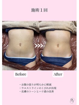 プラスワンビューティテン 新大阪店(Plus One Beauty)/ボディ/ハイパーナイフ/痩身