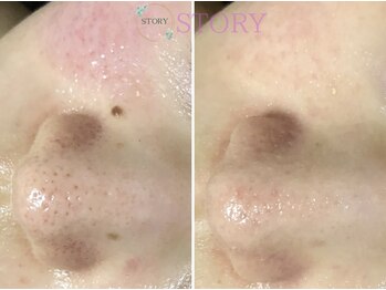 ストーリー(STORY)/眉毛と艶肌ワックス専門店