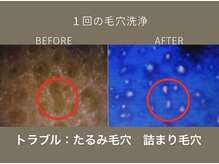 ステラ(Stella)/毛穴トラブル