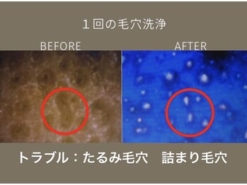 ステラ(Stella)/毛穴トラブル