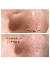 メンズプシュケ(men's PSYCHE)/毛穴エステ