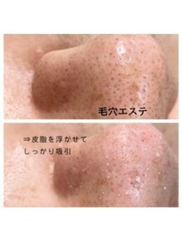 メンズプシュケ(men's PSYCHE)/毛穴エステ