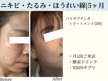 京都フォーエイチ(京都4H)/お肌年齢の逆再生♪