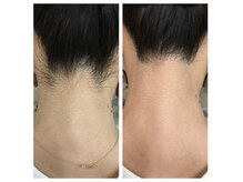 トータルビューティーサロン ナーズ(NAZ)/うなじ脱毛