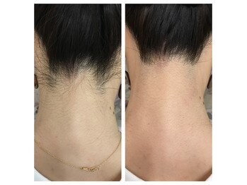 トータルビューティーサロン ナーズ(NAZ)/うなじ脱毛