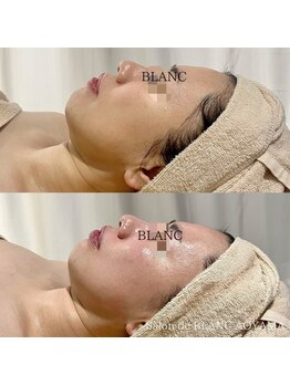 サロン ド ブラン アオヤマ(Salon de BLANC AOYAMA)/ハリツヤアップ