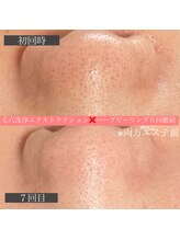 エミーニー(emiiny)/毛穴エクストラクション×ハーブ