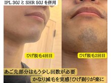 サロン ド クチュリエ(Salon de Couturier)の雰囲気（脱毛人気部位はヒゲ脱毛！1人1人の状態に合わせて照射します。）