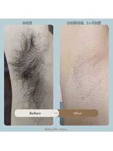 サロン モウ(mou。)/脱毛