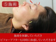 ケンビ(Kenbi)/美容鍼/整体マッサージ/小顔毛穴