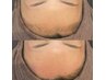 【8月限定】美眉ワックス＋おでこ鼻ワックススペシャルセット9350→8250