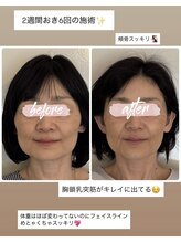 ル メルシェ(Lemerci)/矯正で痩せた？って聞かれる？！