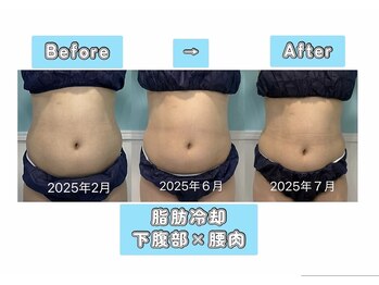 ビーナスアイスブルー(Venus ICE BLUE)/脂肪冷却