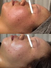 エステ リラクゼーションサロン(more)/ルヴィ陶肌ピール