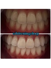 ホワイトニングショップ 三田店/before after