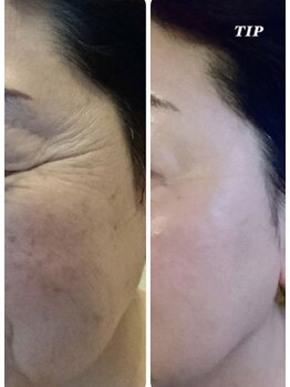 プランス 福岡(PLANCE)/ハーブピーリング福岡天神エステ