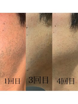 デザインファム(DESIGN FAM)/光脱毛