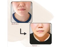 ヴィセル(VISEL)/小顔矯正