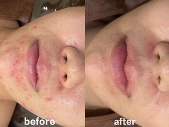 ホワイトアクア 鹿児島店(WHITE AQUA)/ハーブピーリング11回目/鹿児島