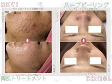 チロル(CHIROL)の雰囲気（話題のREVI陶肌トリートメント大人気です☆）