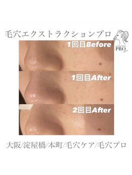 オーバイルッカ(O by RUCCA)/毛穴エクストラクションプロ