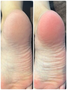 リノ レイ(Lino Ray)/【気になる箇所ピーリング】