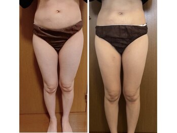 ヨサパーク ラリマー(YOSA PARK Larimar)/ビフォーアフター30代