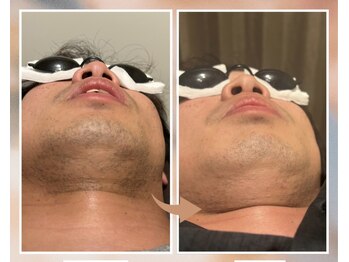 プルベル 平尾(Plus Belle)/ヒゲ脱毛