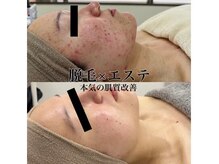 アルゴ 伊勢崎店(ALGO)の雰囲気（脱毛しながら【小顔×美肌×毛穴ケア】が叶うサロンはALGOだけ！）