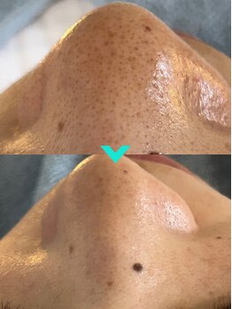 ミルキー(Milky)/お鼻のお悩みも解決