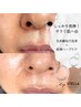 【オイリー肌専用．脱毛穴汚れ☆】高濃度生炭酸毛穴洗浄＋鎮静和漢ハーブケア