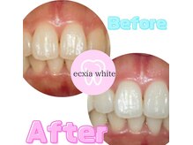 エクシア ホワイトニング 富山店/ビフォーアフター写真☆