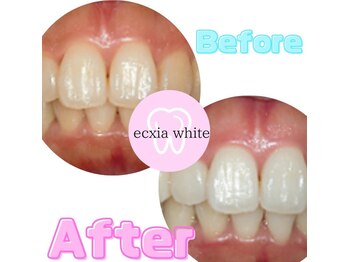 エクシア ホワイトニング 富山店/ビフォーアフター写真☆