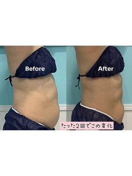 ビーナスアイスブルー(Venus ICE BLUE)/脂肪冷却お腹