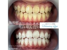 ホワイトニングサロン 熊本店/ホワイトニング熊本