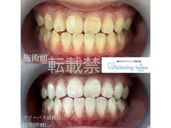 ホワイトニングサロン 熊本店/ホワイトニング熊本