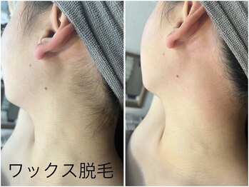 レイズ(RAISE)/うなじ脱毛