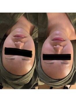 シーアイエステティック 船橋駅前店(c.iエステティック)/レモンボトル★ビフォーアフター