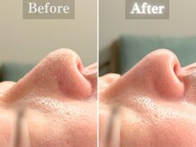 ボーンオム(Born Homme)/毛穴洗浄＋美容液導入：40代男性