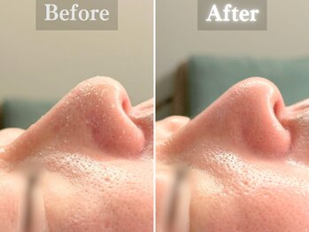 ボーンオム(Born Homme)/毛穴洗浄＋美容液導入：40代男性