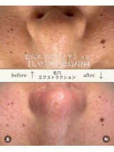 七や美肌/鼻の黒ずみも正しく毛穴ケア