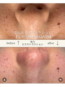 七や美肌/鼻の黒ずみも正しく毛穴ケア